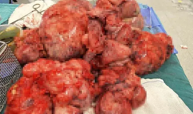 İstanbul'da başarılı operasyon: 60 santimetre çapındaki miyom rahim korunarak çıkarıldı