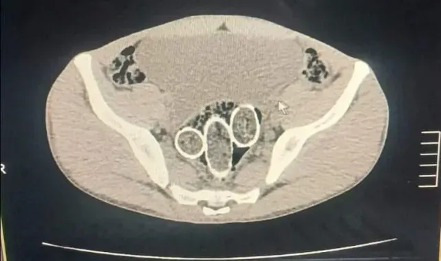 320 gram uyuşturucuyu mide ve rahme sakladılar